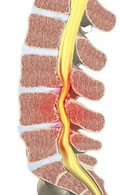 Canal Estrecho Lumbar